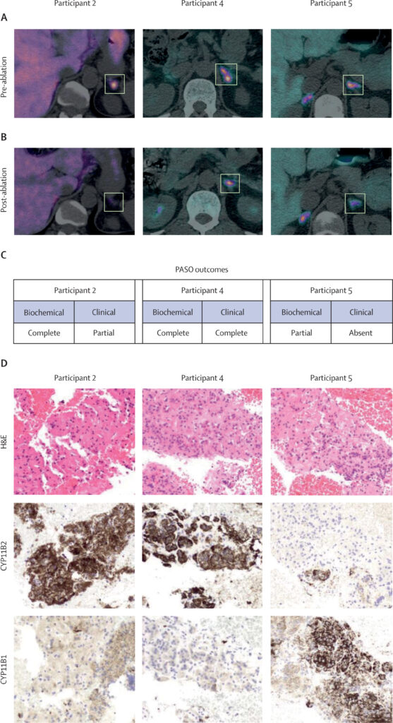 Pre-ablazione e post-ablazione [Immagini e misurazioni PET-CT con C]-metomidato - Credits: The Lancet 