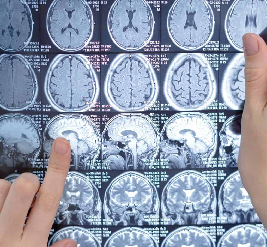 Alzheimer: mitofagia e virus HSV-1 verso la diagnosi precoce - Credits: Freepik