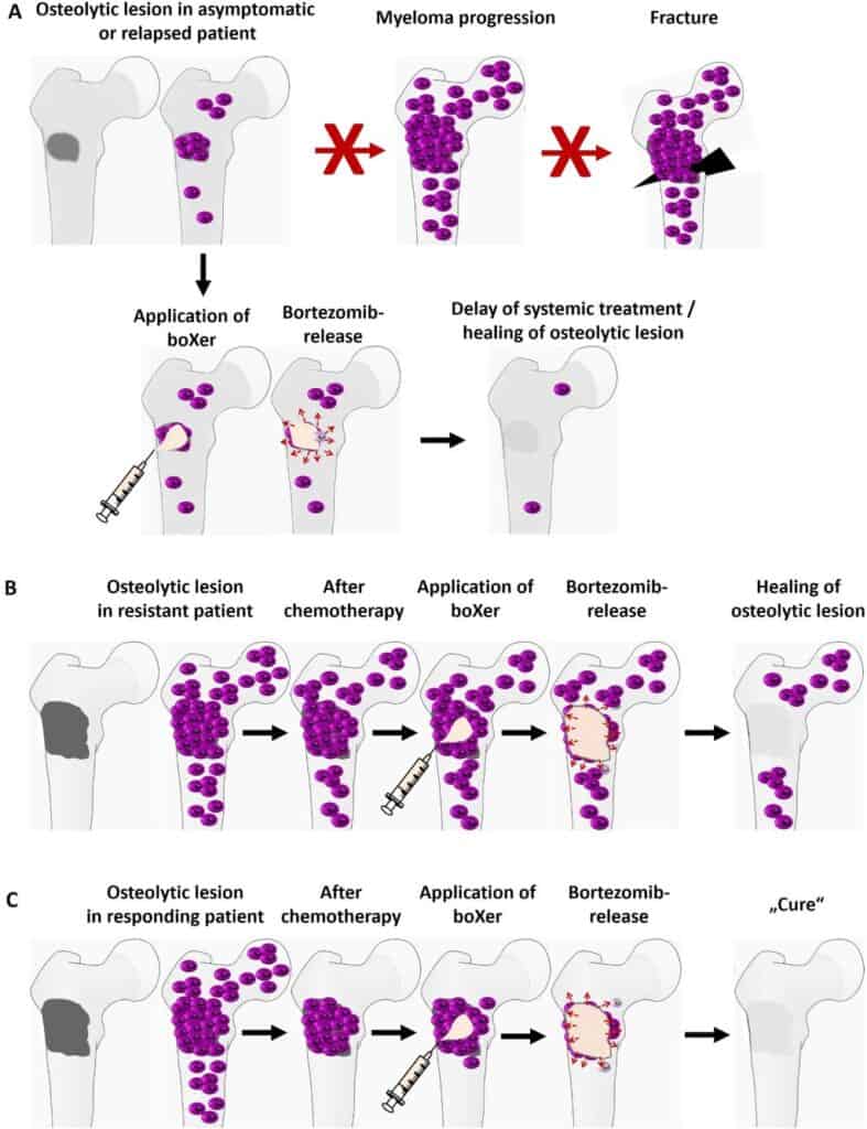 Potenziali applicazioni di sicXer e boXer nel trattamento del mieloma multiplo - Credits: Journal of Hematology & Oncology