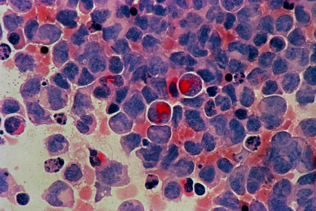 Mieloma multiplo: boXer e sicXer rivoluzionano il trattamento - Credits: National Cancer Institute