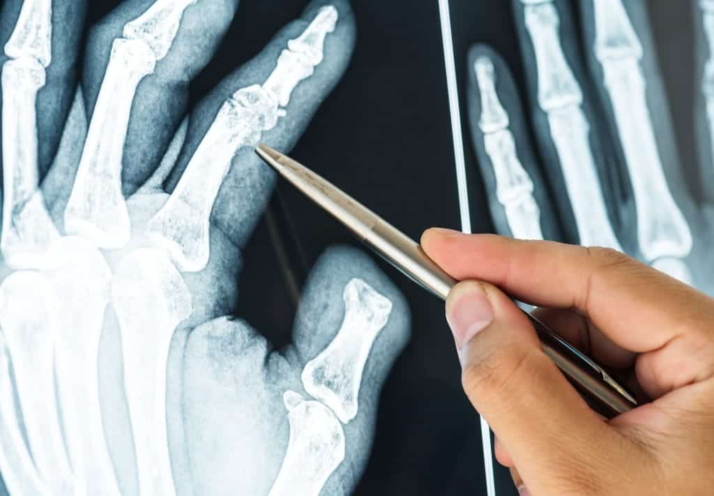 Artrite reumatoide: nuovo farmaco riduce le riacutizzazioni - Credits: Freepik