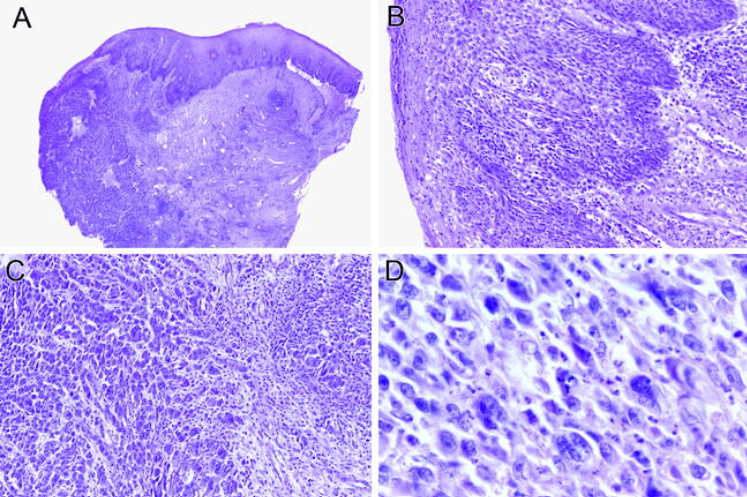A, panoramica di una parte del campione della biopsia prelevato dalla cervice della signora Henrietta Lacks. L'epitelio squamoso in alto a destra appare normale. La porzione di epitelio in alto a sinistra contiene carcinoma in situ, mostrato in B. La parte del campione in basso a sinistra mostra carcinoma infiltrante, come mostrato in C. B, carcinoma in situ con reazione cellulare infiammatoria nello stroma. C, carcinoma infiltrante. D, Carcinoma infiltrante che mostra un marcato pleomorfismo delle cellule maligne (ematossilina-eosina, ingrandimenti originali ×5 [A], ×64 [B e C], ×100 [D]) - Credits: Archives of pathology & laboratory medicine