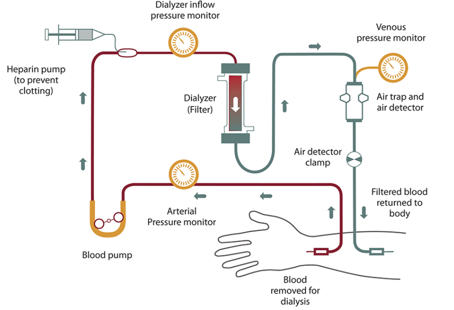 Durante il trattamento il sangue attraversa un filtro, il dializzatore - Credits: National Institute of Diabetes and Digestive and Kidney Diseases (NIDDK)